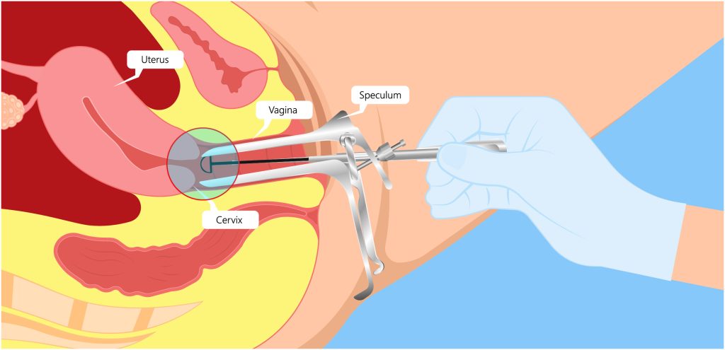 Een gehandschoende hand brengt een speculum in de vagina; baarmoeder, vagina, cervix en speculum zijn gelabeld.