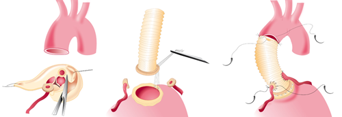 Medische illustratie van drie stappen bij aortachirurgie: aortadeel verwijderen, kunststofprothese plaatsen en vasthechten.