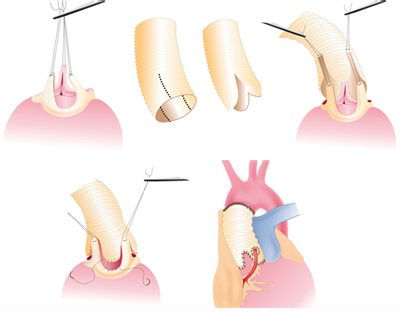 Stapsgewijze medische illustratie van een operatie aan een aneurysma thoracaal met vervanging van het aangedane aortadeel.