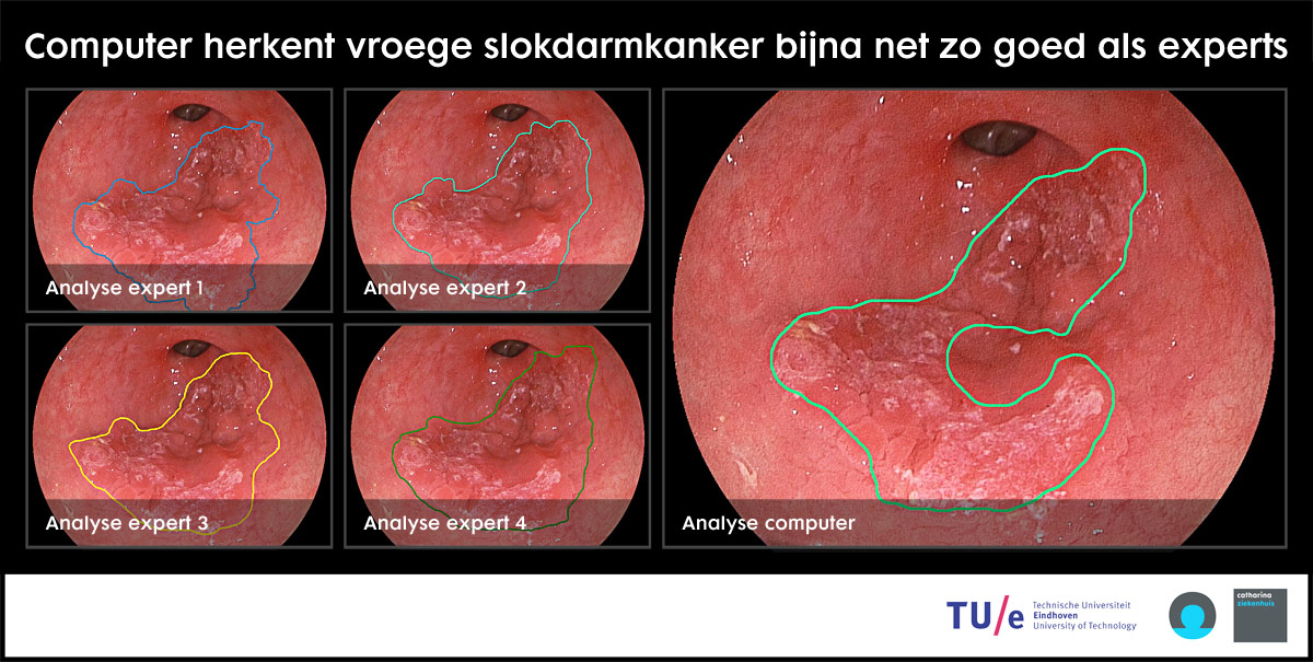 Endoscopische beelden van de slokdarm tonen expert- en computeranalyse met gemarkeerde vroege kanker. TU Eindhoven-logo zichtbaar.