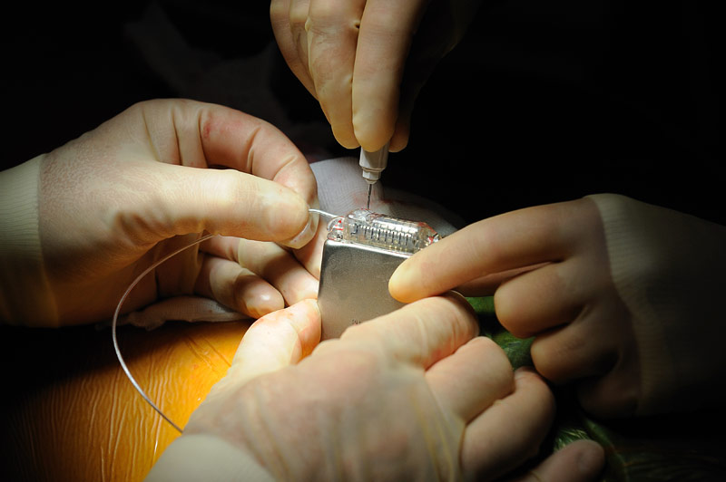 Gehandschoende handen implanteren een medisch apparaat, mogelijk een pacemaker, tijdens een operatie.