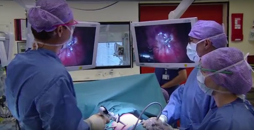 Drie chirurgen voeren een minimale ingreep uit voor een longtumor; patiënt met blauwe doek, drie incisies, omringd door apparatuur.