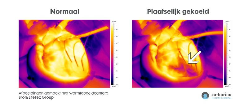 Twee thermische hartbeelden: links 'Normaal', rechts 'Plaatselijk gekoeld' met pijl bij koeler gebied. Temperatuurschalen zichtbaar.