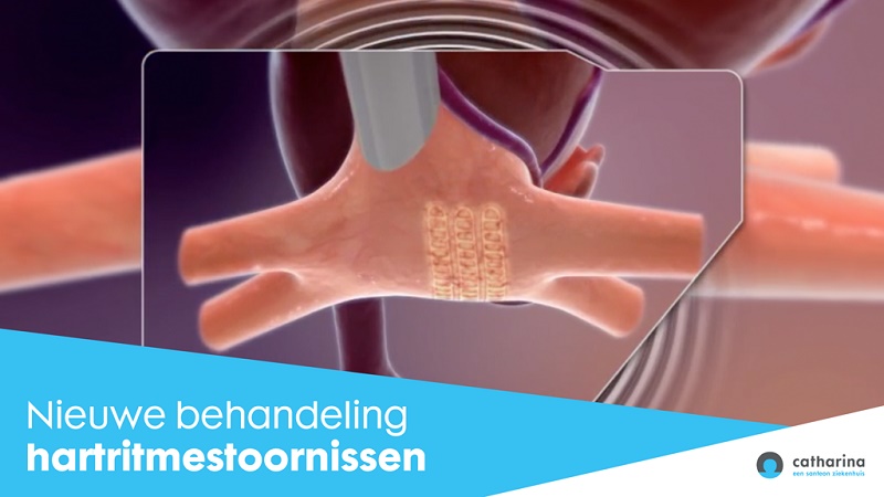 Medische illustratie met stentachtig apparaat in hartvat, tekst: Nieuwe behandeling hartritmestoornissen, Catharina-logo.