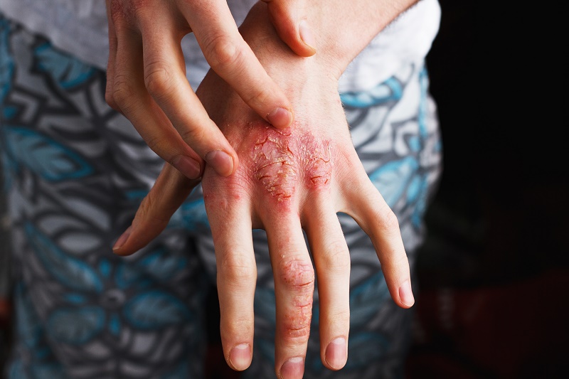 Iemand raakt de rode, droge en gebarsten huid met irritatie aan de hand aan. Op de achtergrond patroon op kleding.