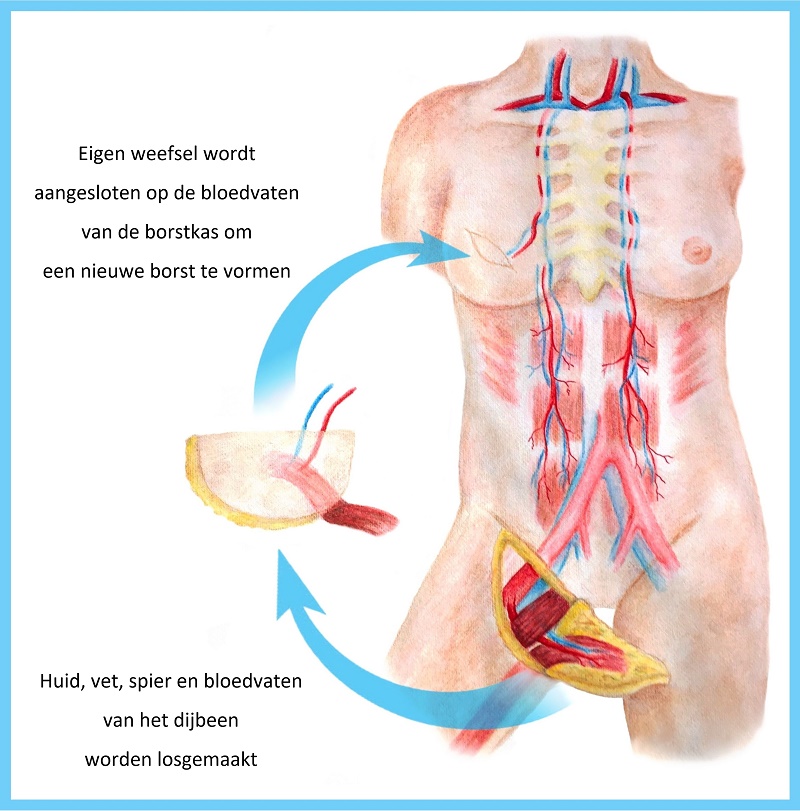 Medische illustratie van borstreconstructie: weefsel uit het dijbeen verbonden met de borst, met uitleg in het Nederlands.