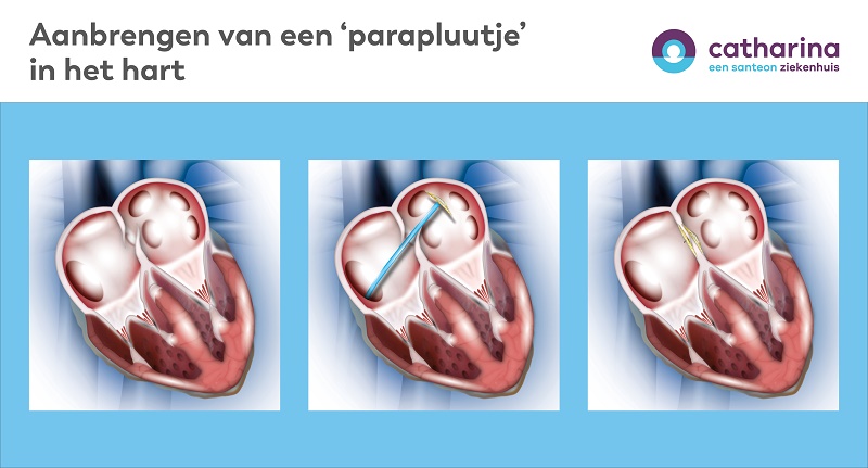 Drie medische illustraties tonen plaatsing van een parapluutje tussen hartboezems. Catharina Ziekenhuis-logo rechtsboven.