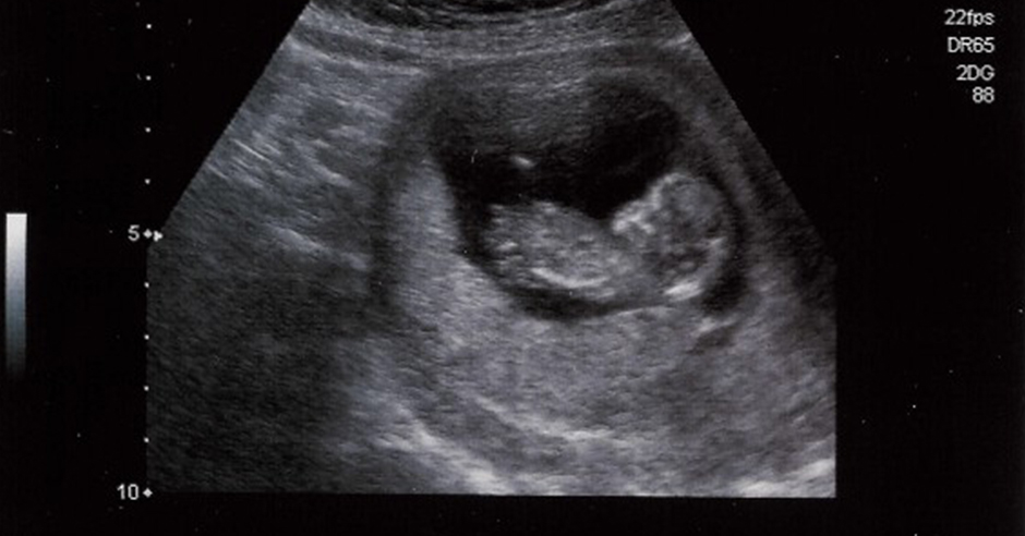 Een zwart-wit echo toont een foetus in de baarmoeder, met meetgegevens en technische details aan beide zijden van het scherm.