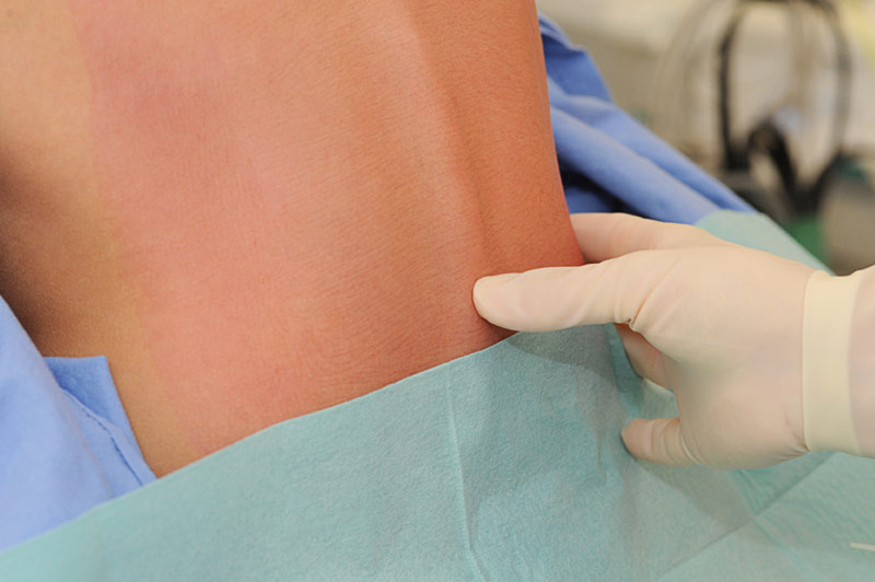 Een gehandschoende hand raakt de blote onderrug van een patiënt aan, die op Herniastraat voor een ingreep ligt afgedekt.