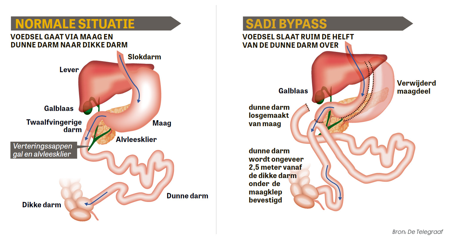 Twee diagrammen tonen normale spijsvertering en SADI-operatie bij extreem overgewicht, met verschil in darmomleiding.