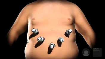 Digitale illustratie van een stoeipartij met vijf poorten in de buik, die de instrumentplaatsen bij een gastric sleeve laten zien.