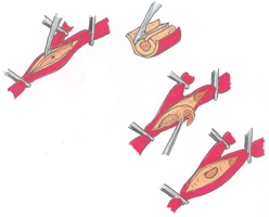 Illustratie van een halsslagaderoperatie met klemmen en instrumenten voor snijden, manipuleren en binnenwand reinigen.