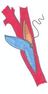 Tekening van een blauw chirurgisch instrument dat in een rode halsslagader snijdt, met nabij een zwarte hechtdraad.