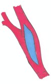 Eenvoudige tekening van een roze halsslagader met een blauwe driehoekige vernauwing die de bloedstroom blokkeert.