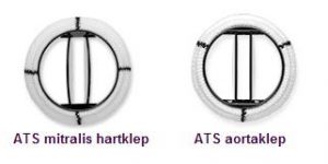 Twee kunsthartkleppen naast elkaar, links ATS mitralisklep, rechts ATS aortaklep, beide met ronde ringen en twee klepbladen.