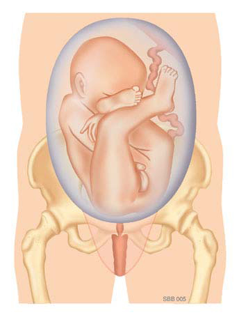 Medische illustratie van een foetus in foetushouding in de baarmoeder met zicht op uterus, bekken en navelstreng.