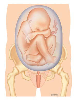 Illustratie van een foetus in stuitligging in de vruchtzak met navelstreng; bekkenbodem zichtbaar op de achtergrond.