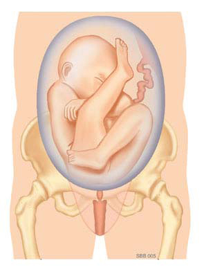 Medische illustratie van een foetus in stuitligging in de vruchtzak, boven het bekken en het geboortekanaal.