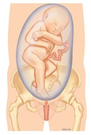 Medische illustratie van een foetus in stuitligging in de baarmoeder, met vruchtzak, navelstreng en bekken zichtbaar.
