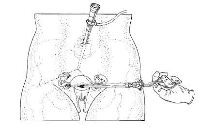 GYN041