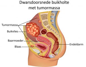 Doorsnede van vrouwelijke buik met tumor boven de baarmoeder, peritoneum, blaas en endeldarm, ter voorbereiding op OVHIPEC.