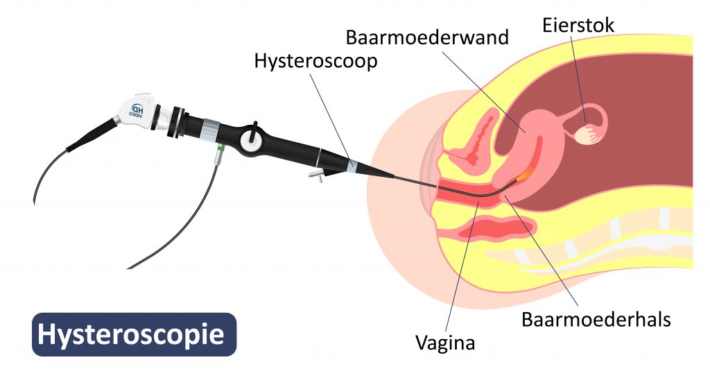 Schema van hysteroscopie: een hysteroscoop via vagina en baarmoederhals in de baarmoeder, gelabelde organen.
