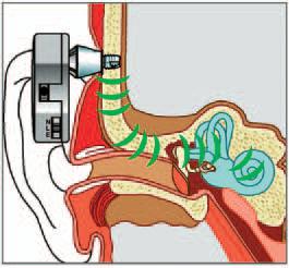 Diagram van cochleair implantaat met externe en interne delen; geluidsgolven gaan via oor en cochlea naar de gehoorzenuw.
