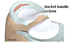 Medische illustratie van een knie met een in rood gemarkeerde bucket handle scheur in de meniscus, label "bucket handle scheur".