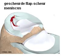 Medische illustratie van een kniegewricht met een rode flap-scheur in de meniscus, gelabeld als 'gescheurde meniscus'.