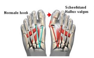 Medische illustratie van twee voeten: links normale stand, rechts hallux valgus met scheve grote teen. Verschil aangeduid met lijnen.