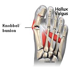 Medische illustratie van een voet met botten en een rode plek bij de grote teen, hallux valgus en een pijl naar de knobbel.