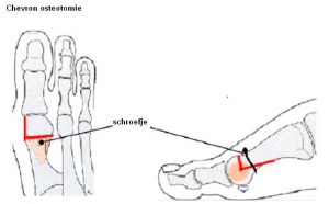 Diagram van een Chevron osteotomie bij hallux valgus met rode lijnen voor botzaagsneden en pijl naar schroefje bij grote teen.
