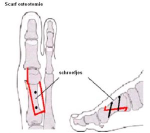 Medische illustratie voet met botlabels, zaaglijnen en schroefplaatsen voor Scarf osteotomie bij scheefstand grote teen.
