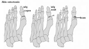 Drie diagrammen van een linker voet tonen Akin-osteotomie bij hallux valgus: wigje verwijderen en bot vastzetten met nietje.