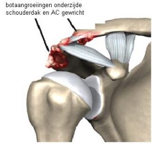 Medische illustratie van schoudergewricht met botuitsteeksels, spieren en pezen zichtbaar; Nederlandse tekst bovenaan.
