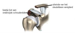 Medische illustratie van het schoudergewricht met Nederlandse labels, aandacht voor onderzijde acromion en verwijderde clavicula.