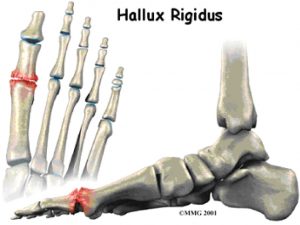 Medische illustratie van voet- en teengewrichten met rood gemarkeerde ontsteking bij hallux rigidus, boven- en zijaanzicht.