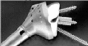 Röntgenfoto toont een metalen schouderprothese met meerdere schroeven, bevestigd aan het bot van het schoudergewricht.