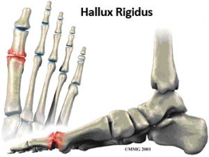 Medische illustratie van voetbotten met hallux rigidus; ontsteking bij grote teen in rood gemarkeerd.