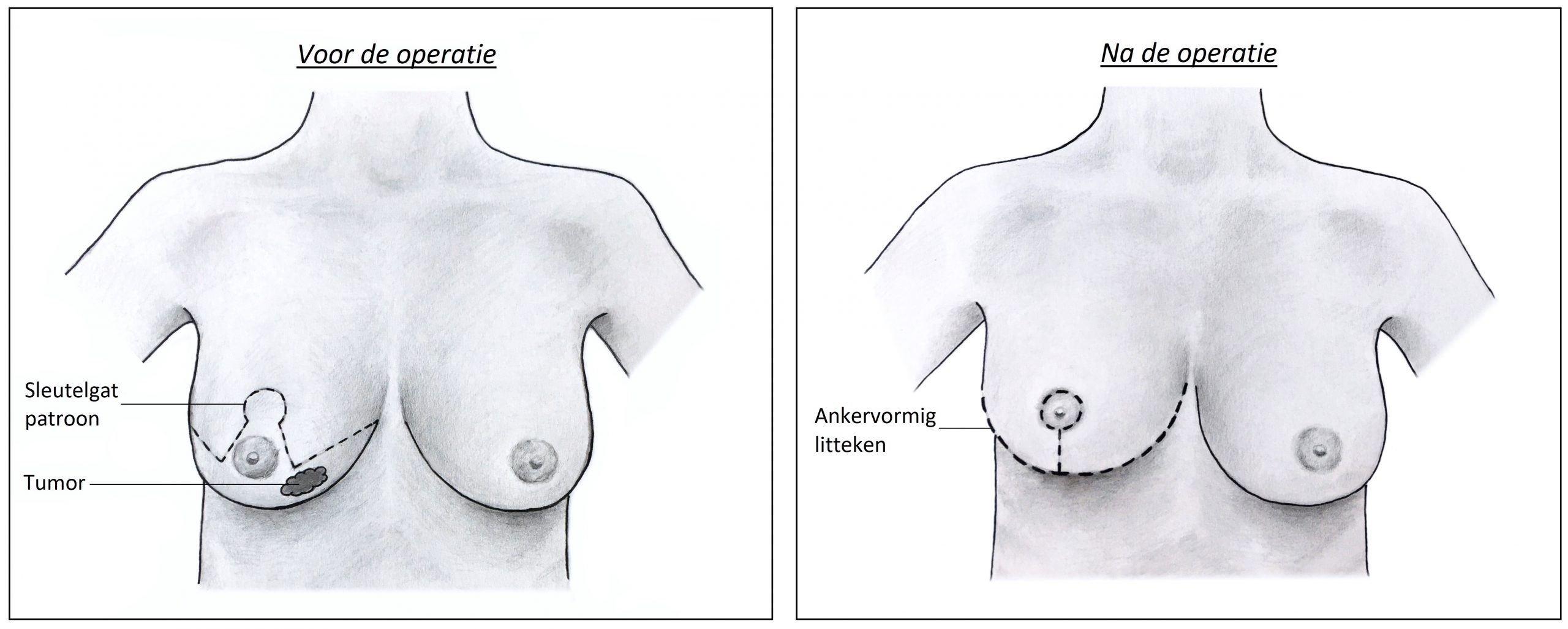 Oncoplastische reductie - voor en na.jpg
