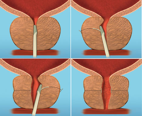 Urolift 1.jpg