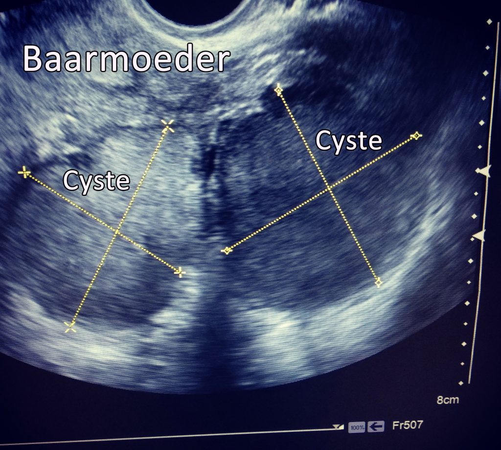 Echobeeld van baarmoeder met twee cysten gemarkeerd, mogelijk endometriose. Gele stippellijnen geven de grootte aan.