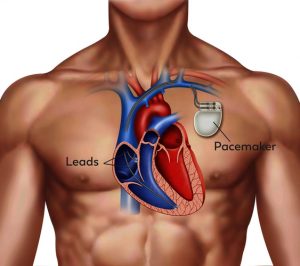 Medische illustratie van mannentorso met pacemaker in de borst, draden verbinden het apparaat met het hart, gelabeld.