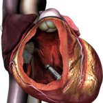 Doorsnede van een menselijk hart met pacemaker in de rechterkamer; hartstructuren en bloedvaten duidelijk zichtbaar.