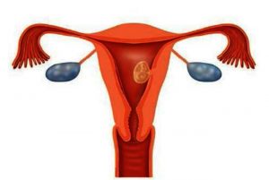 Diagram van vrouwelijk voortplantingsstelsel met embryo in de baarmoederwand, eileiders en eierstokken.