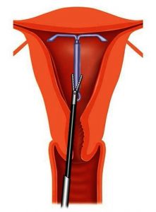 Medische illustratie van het inbrengen van een T-vormig spiraaltje (IUD) in de baarmoeder met instrument.