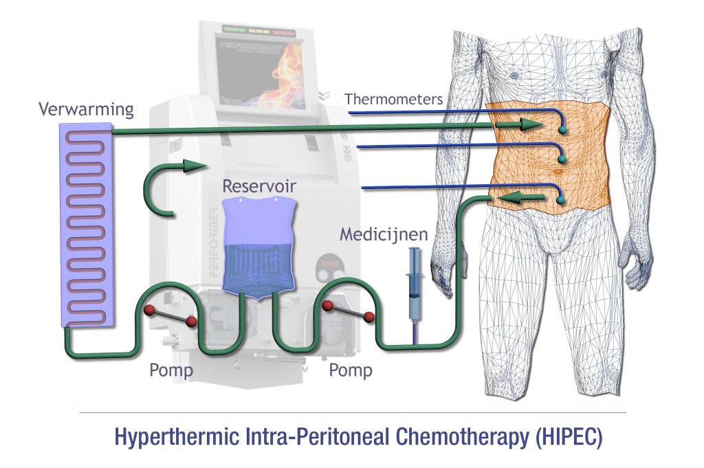 Schema van de OVHIPEC-operatie, waarbij verwarmde chemotherapie door de buik stroomt via een systeem met reservoir en pompen.