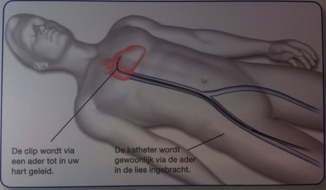 Mitraclip 5.jpg