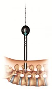 Illustratie van een medisch instrument dat verticaal in de wervelkolom wordt ingebracht, met onderaan een rugwervelfractuur.