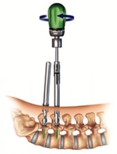 Illustratie van een instrument dat twee schroeven in de onderrug plaatst bij een gebroken wervel; hand en pijlen zichtbaar.